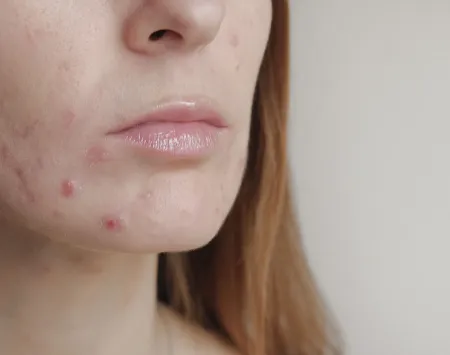 Acne prone skin